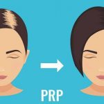PRP treatment and its pros